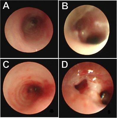 Tracheal reconstructive surgery under ECMO for the treatment of congenital tracheal stenosis in the premature infant: case report